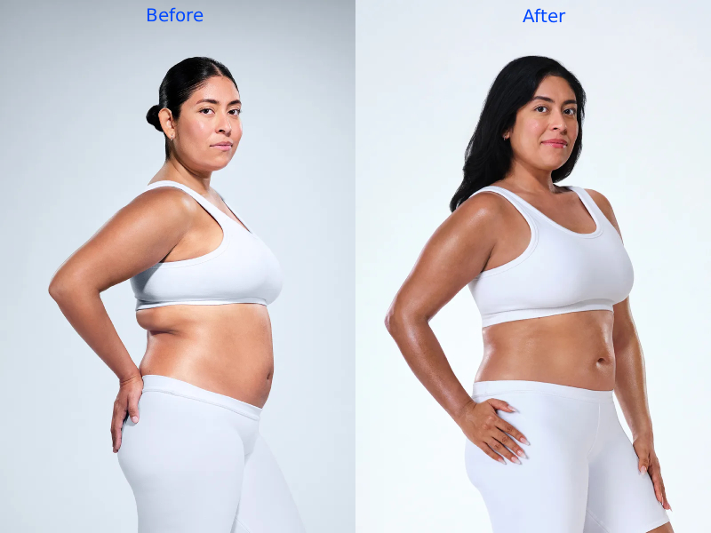 CoolSculpting Before-After
